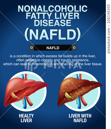 Nonalcoholic fatty liver disease Nonalcoholic fatty liver disease 108148305