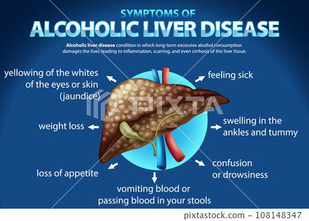 Informative poster of alcoholic liver disease Cirrhosis Informative poster of alcoholic liver disease Cirrhosis 108148347