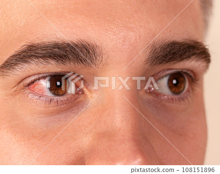 Red and inflamed eye close-up. Patient's red eye. Allergic reaction 108151896