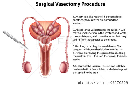 Surgical Vasectomy Procudure infographic with explanation 108170209
