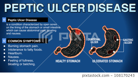 Peptic Ulcer Disease Explained Infographic Peptic Ulcer Disease Explained Infographic 108170243