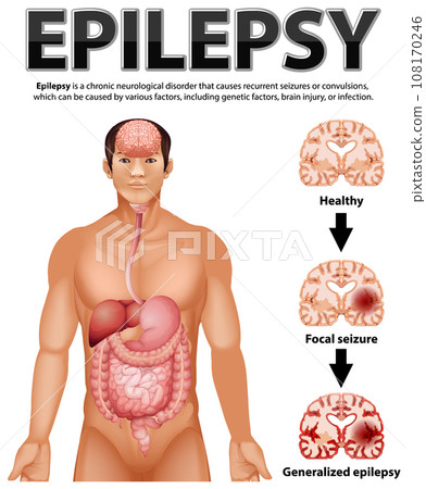Informative poster of Epilepsy 108170246