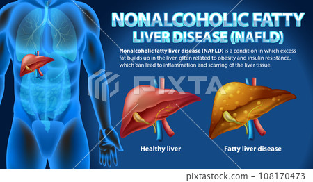 Nonalcoholic Fatty Liver Disease (NAFLD) Nonalcoholic Fatty Liver Disease (NAFLD) 108170473