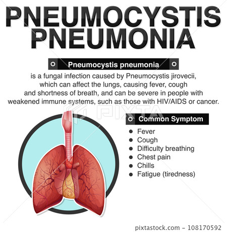 Informative poster of Pneumocystis Pneumonia 108170592