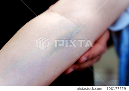 Bleeding, after blood drawing testing for annually physical health check up to check cholesterol, blood pressure, and sugar level. 108177559