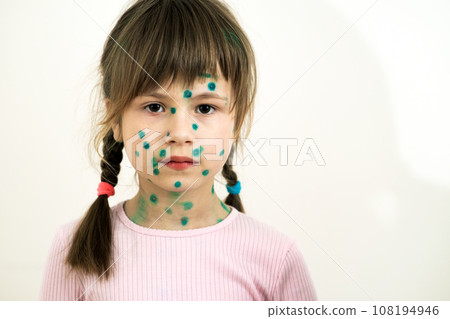 Child girl covered with green rashes on face ill with chickenpox, measles or rubella virus. Child girl covered with green rashes on face ill with chickenpox, measles or rubella virus. 108194946