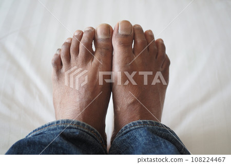 close up of young men dry feet on bed  108224467