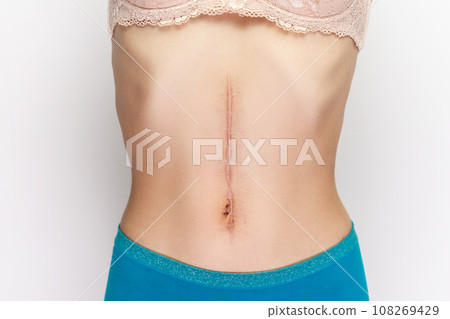 Closeup portrait of young woman with large scar after surgery on abdomen, naked belly with scar after cesarean. Indoor studio shot isolated on gray background. 108269429