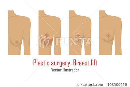 Lifting breast plastic surgery 108309656