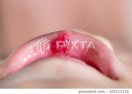 Little boy with injury on his lip. 108315258