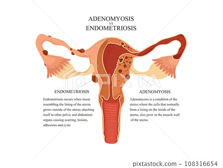 Adenomyosis vs endometriosis. Anatomical illustration of the female reproductive system with symptoms of adenomyosis, with annotations. 108316654