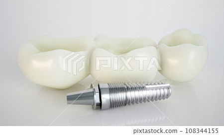 Dental Implant: Modern Solution for Tooth Replacement Dental Implant: Modern Solution for Tooth Replacement 108344155