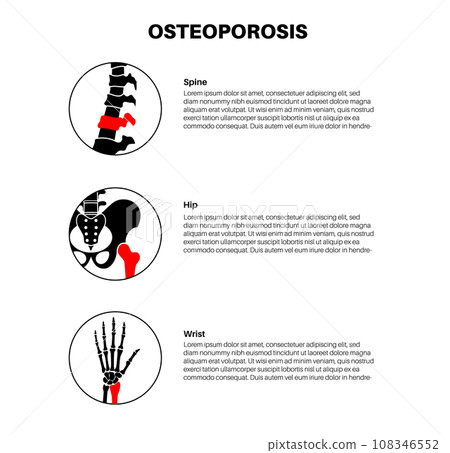 Osteoporosis medical poster 108346552
