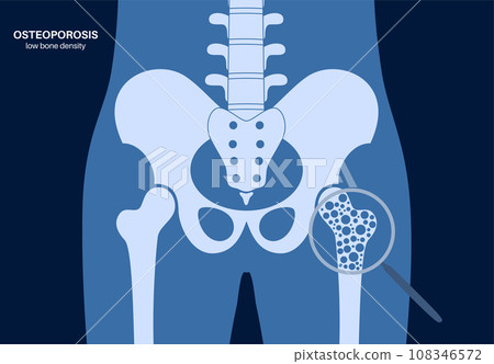 Osteoporosis medical poster Osteoporosis medical poster 108346572
