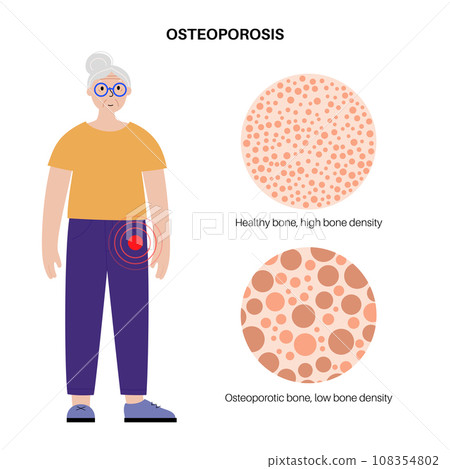 Osteoporosis medical poster 108354802