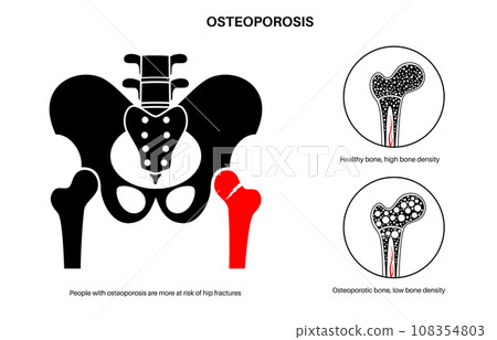 Osteoporosis medical poster 108354803
