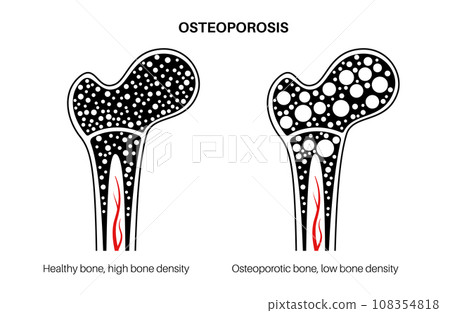 Osteoporosis medical poster 108354818