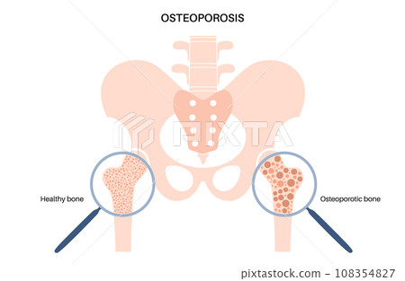 Osteoporosis medical poster 108354827