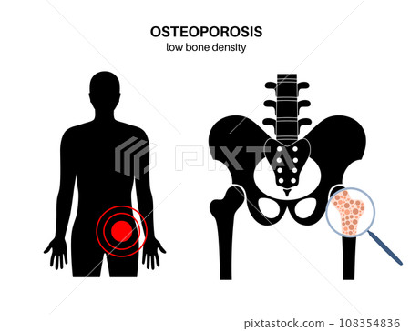 Osteoporosis medical poster Osteoporosis medical poster 108354836