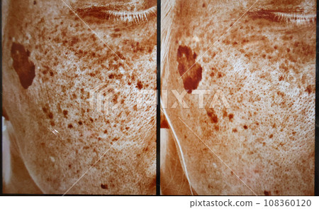 使用 VISIA 機器拍攝的斑點（黃褐斑、老年色素斑）的偏光影像，棕色斑點的分析模式 108360120