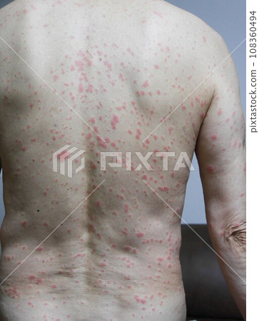 Drug eruption 108360494