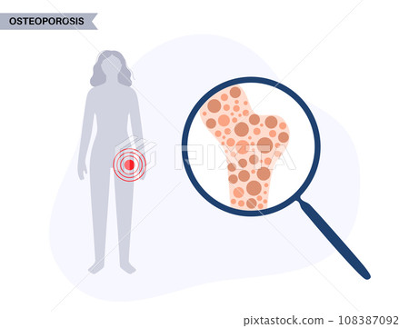 Osteoporosis medical poster 108387092