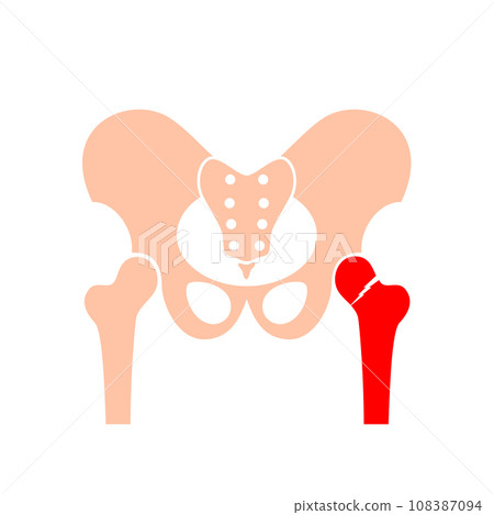 Hip bone fracture 108387094