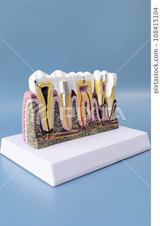 Dental Tooth Implant, Bridge Or Crown Model On Blue Background, Copy Space. Dummy Mockup Human Jaw Oral Dentures. Prosthesis On Metal Peg. Vertical Plane. Dental Tooth Implant, Bridge Or Crown Model On Blue Background, Copy Space. Dummy Mockup Human Jaw Oral Dentures. Prosthesis On Metal Peg. Vertical Plane. 108415104