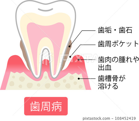 Periodontal disease cross section 108452419