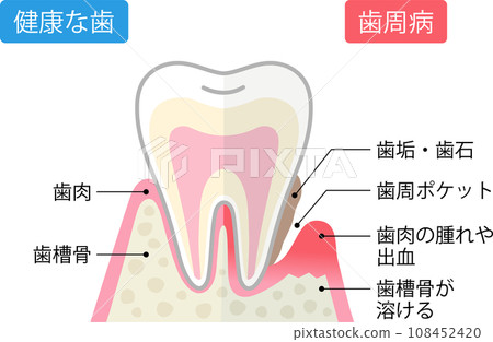 Comparison cross-sectional view of periodontal disease and healthy teeth Comparison cross-sectional view of periodontal disease and healthy teeth 108452420