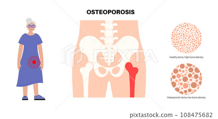 Osteoporosis medical poster 108475682