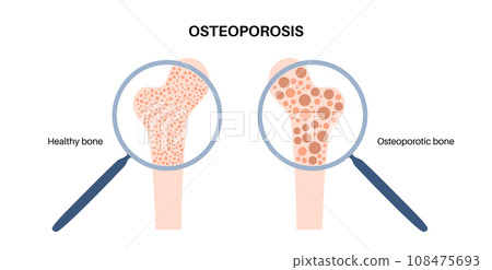 Osteoporosis medical poster 108475693