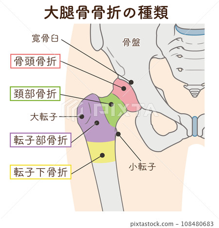 pelvis, femur, fracture, femur fracture, femoral neck fracture, illustration 108480683