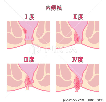 內痔依進展階段分類的圖示 內痔依進展階段分類的圖示 108507898