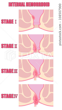 Illustration of classification of internal hemorrhoids by stage of progression 108507900