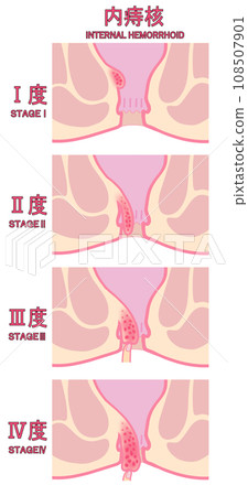 Illustration of classification of internal hemorrhoids by stage of progression 108507901