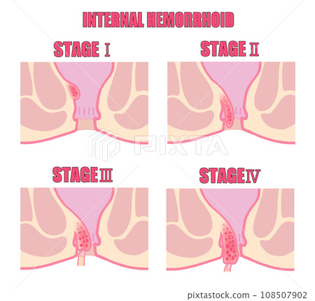 Illustration of classification of internal hemorrhoids by stage of progression Illustration of classification of internal hemorrhoids by stage of progression 108507902