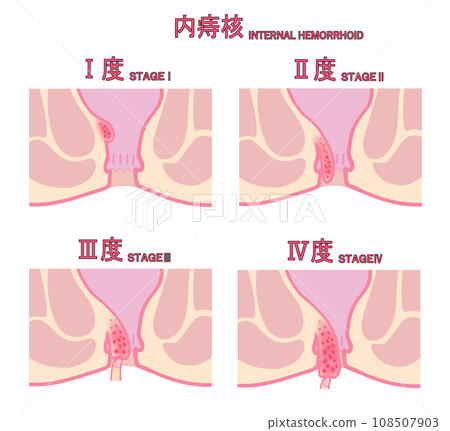 內痔依進展階段分類的圖示 內痔依進展階段分類的圖示 108507903
