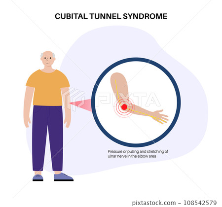 Cubital tunnel syndrome 108542579