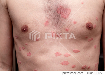 Psoriasis Vulgaris, skin patches are typically red, itchy, and scaly. Papules of chronic psoriasis vulgaris on male hand, back and body. Genetic immune disease. Detail of psoriatic skin disease  108560172