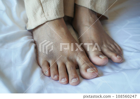 close up of women feet with swelling  108560247