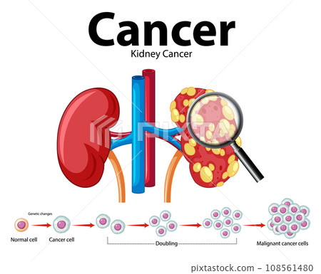 Cancer Development Process in Human Kidney: An Infographic Cancer Development Process in Human Kidney: An Infographic 108561480