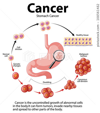 Stomach Cancer: Abnormal Cell Growth Infographic 108561482