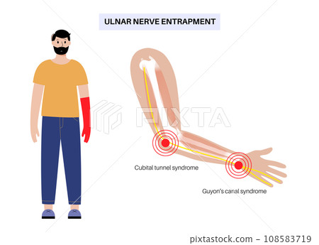 Ulnar nerve entrapment 108583719