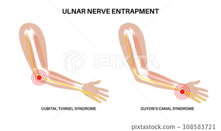 Ulnar nerve entrapment Ulnar nerve entrapment 108583721