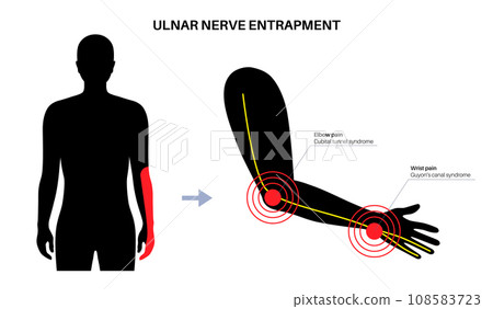Ulnar nerve entrapment 108583723