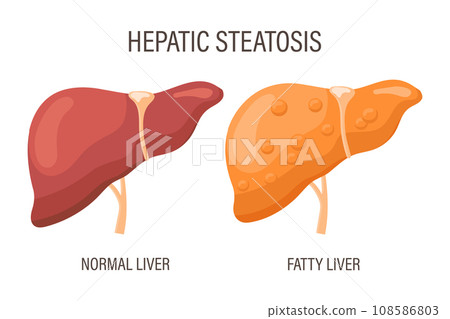 Liver steatosis, liver diseases. Healthy liver and fatty liver. Medical infographic banner. Vector Liver steatosis, liver diseases. Healthy liver and fatty liver. Medical infographic banner. Vector 108586803