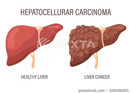 Hepatocellular carcinoma, liver diseases. Healthy liver and liver cancer. Medical infographic banner. Vector Hepatocellular carcinoma, liver diseases. Healthy liver and liver cancer. Medical infographic banner. Vector 108586805