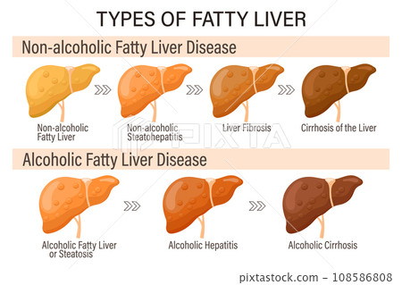 Types of fatty liver. Human liver diseases. Alcoholic and non-alcoholic fatty liver. Hepatitis, liver cirrhosis, fibrosis, steatosis. Medical infographic banner. Vector 108586808