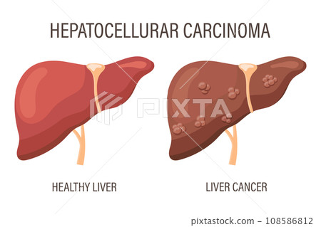 Hepatocellular carcinoma, liver diseases. Healthy liver and liver cancer. Medical infographic banner. Vector Hepatocellular carcinoma, liver diseases. Healthy liver and liver cancer. Medical infographic banner. Vector 108586812
